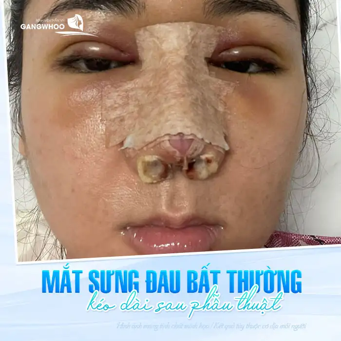 Bị nhức hốc mắt khi nâng mũi nguyên nhân là gì? Có phải là biến chứng không?