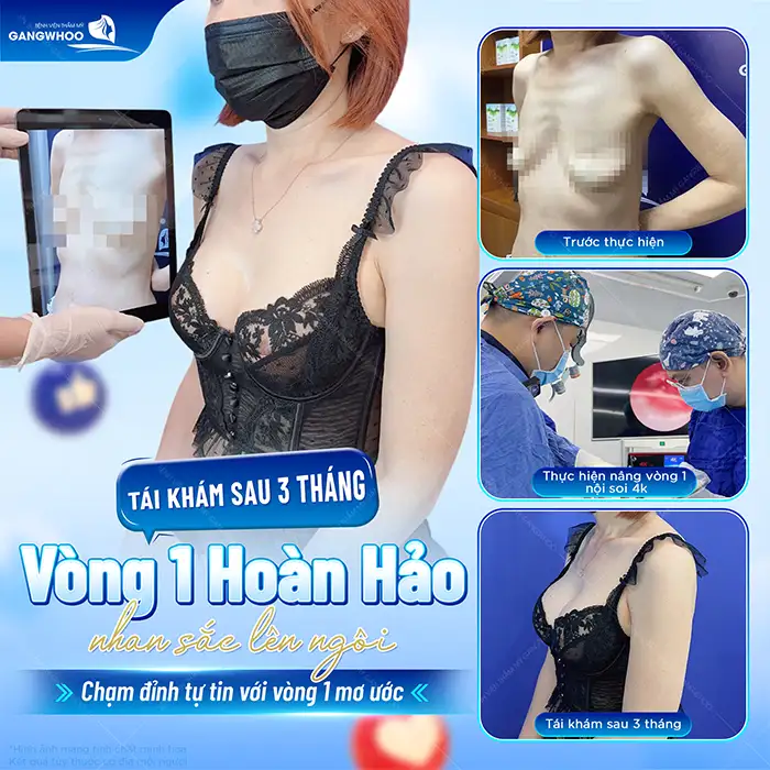 Quá trình hồi phục sau nâng ngực như thế nào? Cách chăm sóc đúng cách