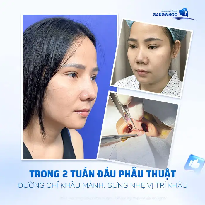 Sau khi nâng mũi có thấy đường chỉ không? Cách chăm sóc giúp vết thương nhanh lành