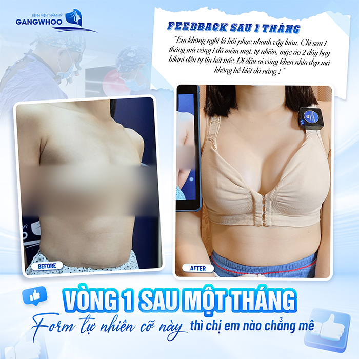 Sau khi nâng ngực bao lâu thì hết đau và sưng? Cách giảm đau hiệu quả
