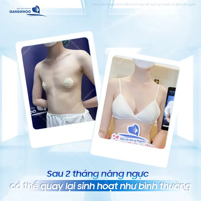 Sau khi nâng ngực cần kiêng gì? Những lưu ý sau khi nâng ngực