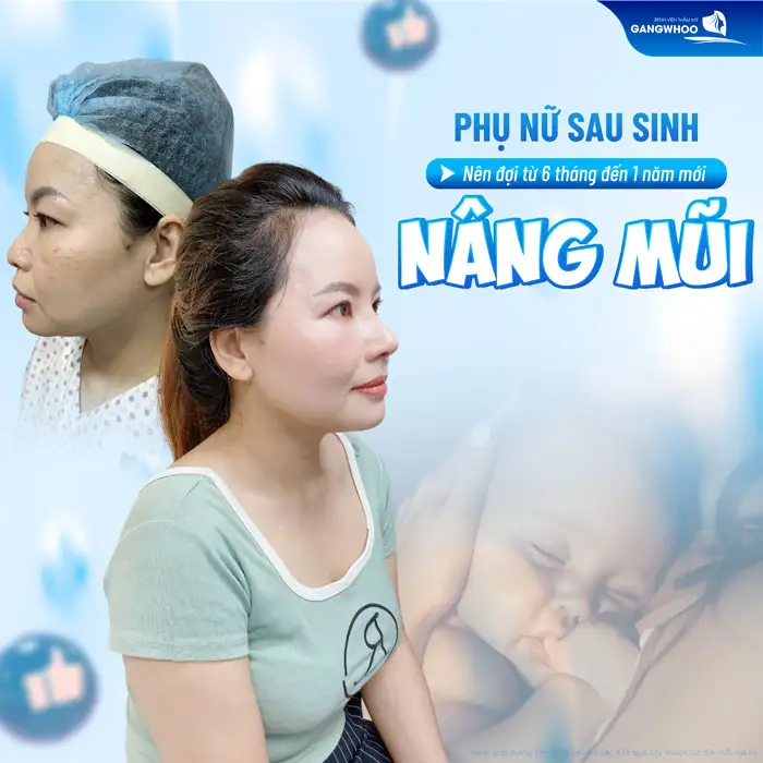 Sau sinh bao lâu thì nâng mũi được? Có thể nâng mũi ngay sau sinh được không?