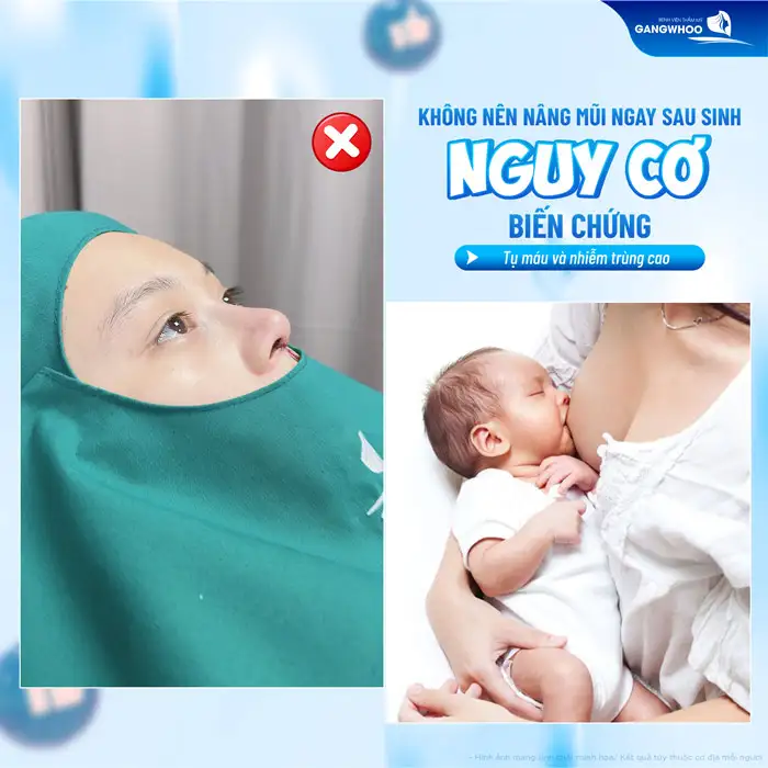 Sau sinh bao lâu thì nâng mũi được? Có thể nâng mũi ngay sau sinh được không?