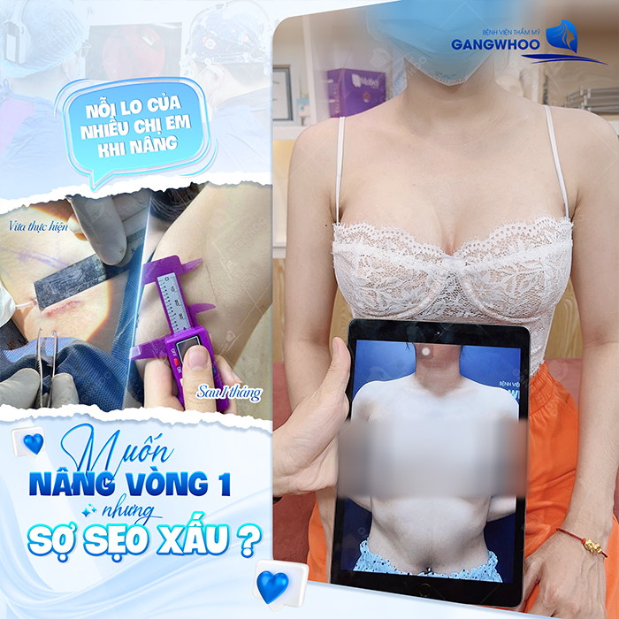 Sẹo nâng ngực là gì? Có mấy loại sẹo và cách hạn chế sẹo khi nâng