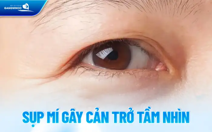 Tác hại của cắt mí mắt là gì? Ảnh hưởng đến sức khỏe ra sao?