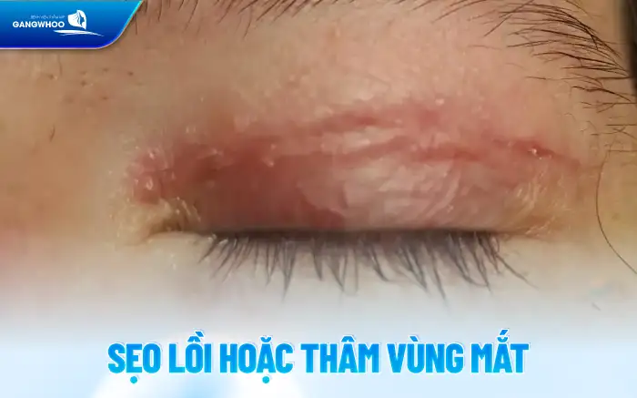 Tác hại của cắt mí mắt là gì? Ảnh hưởng đến sức khỏe ra sao?