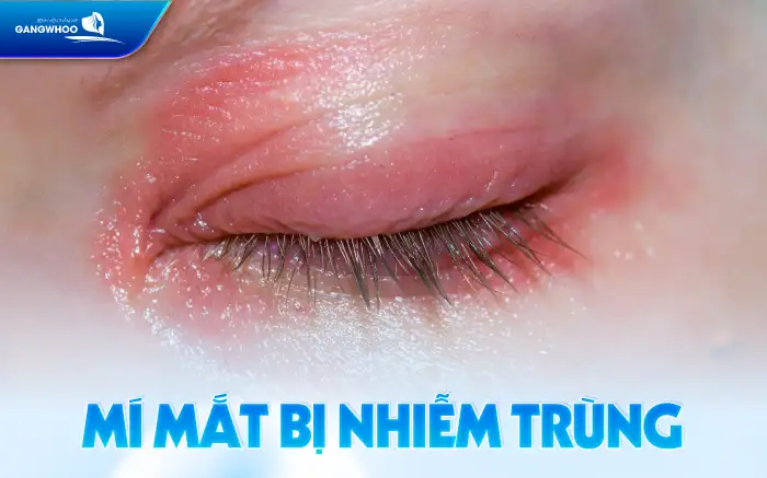 Tác hại của cắt mí mắt là gì? Ảnh hưởng đến sức khỏe ra sao?