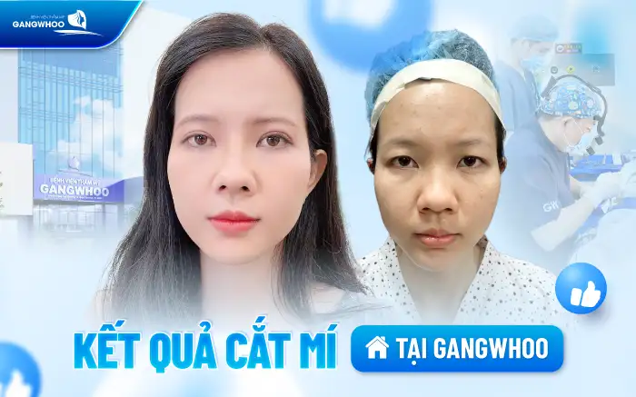 Tác hại của cắt mí mắt là gì? Ảnh hưởng đến sức khỏe ra sao?