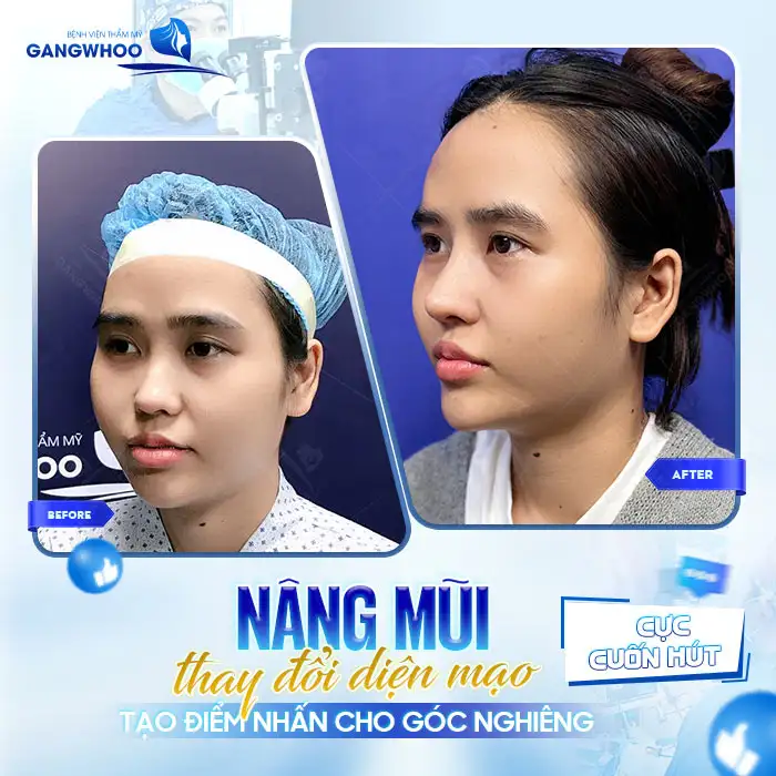 Tiêm botox nâng mũi là gì? Có nên lựa chọn phương pháp tiêm botox nâng mũi