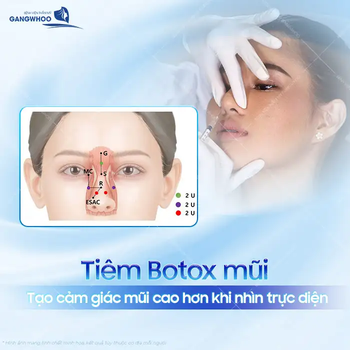 Tiêm botox nâng mũi là gì? Có nên lựa chọn phương pháp tiêm botox nâng mũi