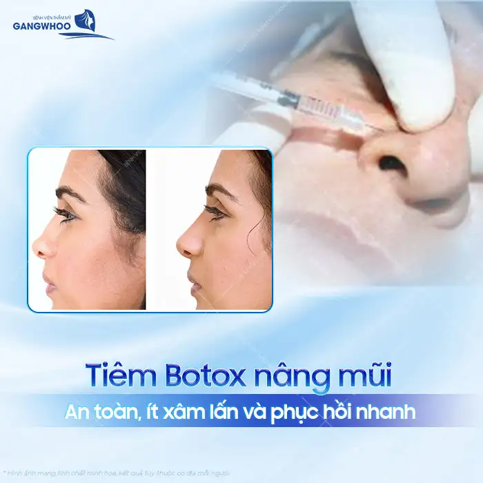 Tiêm botox nâng mũi là gì? Có nên lựa chọn phương pháp tiêm botox nâng mũi