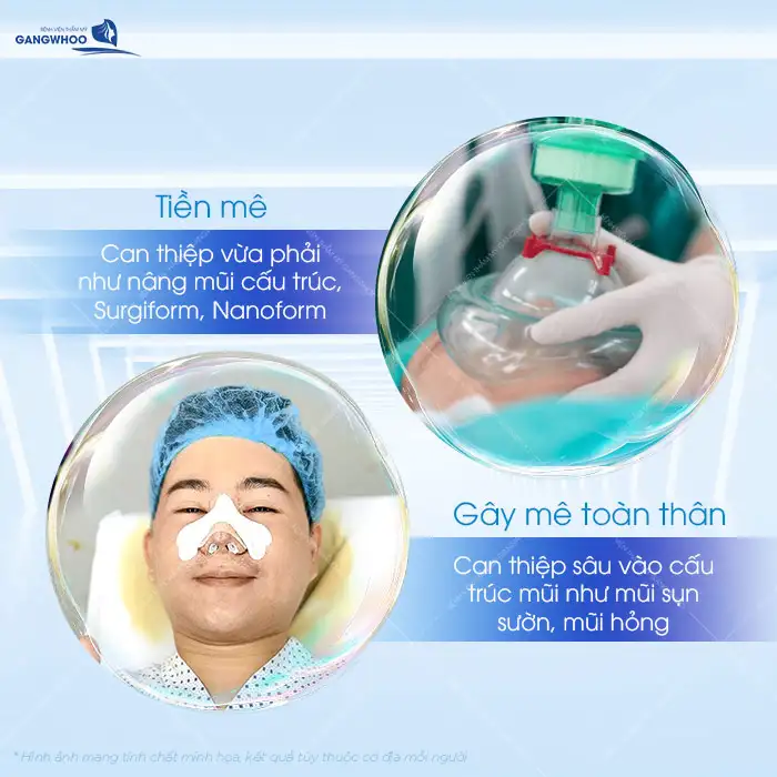 Tiền mê khi nâng mũi là gì? Nên gây mê hay tiền mê khi nâng mũi
