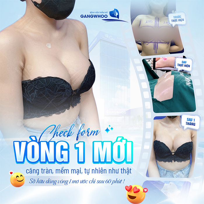 Tìm hiểu các túi nâng ngực phổ biến hiện nay? Nên chọn loại túi nâng ngực nào