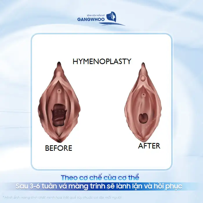 Vá màng trinh bao lâu thì lành? Những lưu ý chăm sóc sau khi vá