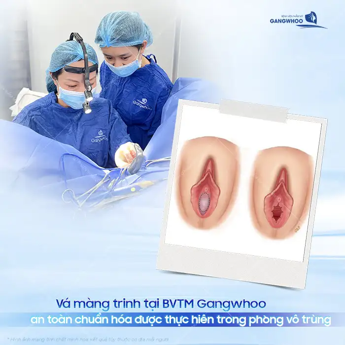 Vá màng trinh bao nhiêu tiền? Cập nhật giá vá màng trinh mới nhất 2025 3 Vá màng trinh bao nhiêu tiền? Cập nhật giá vá màng trinh mới nhất 2025