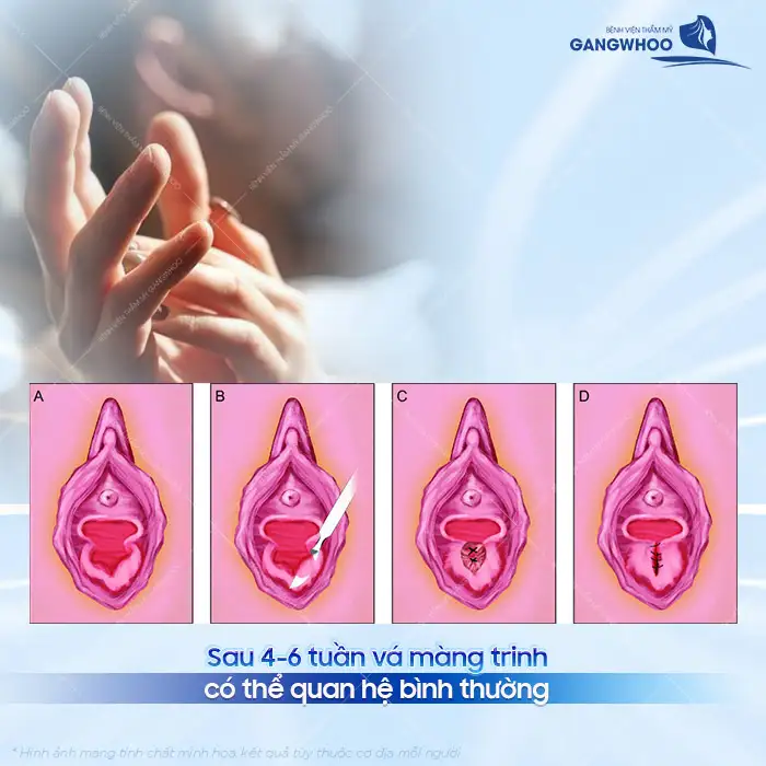 Vá màng trinh để được bao lâu? Khi nào thì có thể quan hệ được