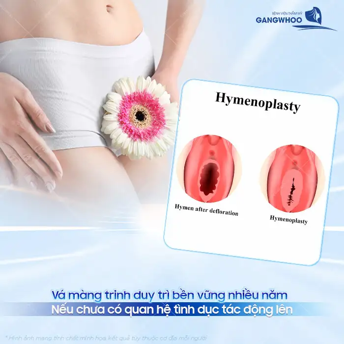 Vá màng trinh để được bao lâu? Khi nào thì có thể quan hệ được