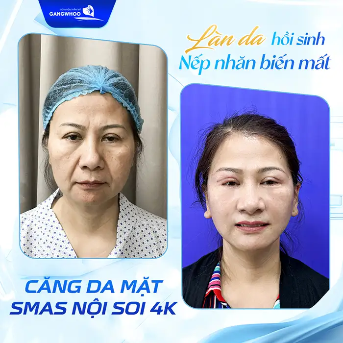 Ăn gì để da mặt căng mịn, trắng sáng? Nên tránh các loại thực phẩm nào?