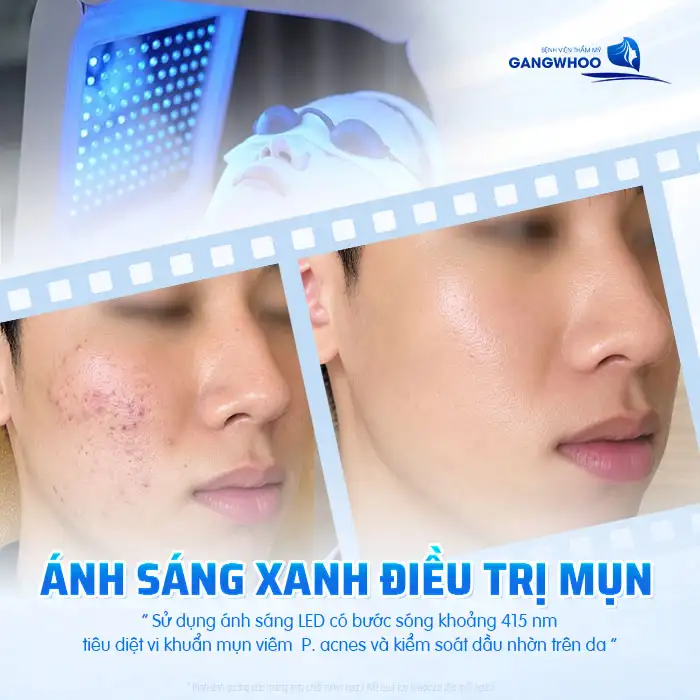 Sử dụng ánh sáng xanh điều trị mụn có tốt không? Lưu ý khi thực hiện