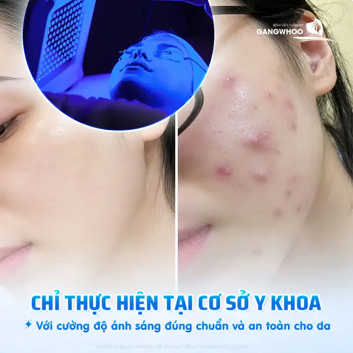 Sử dụng ánh sáng xanh điều trị mụn có tốt không? Lưu ý khi thực hiện