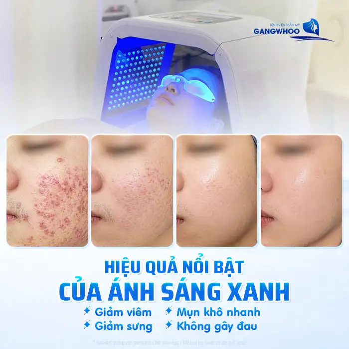 Sử dụng ánh sáng xanh điều trị mụn có tốt không? Lưu ý khi thực hiện