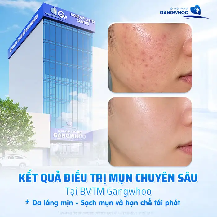 Sử dụng ánh sáng xanh điều trị mụn có tốt không? Lưu ý khi thực hiện