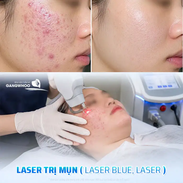 Sử dụng ánh sáng xanh điều trị mụn có tốt không? Lưu ý khi thực hiện