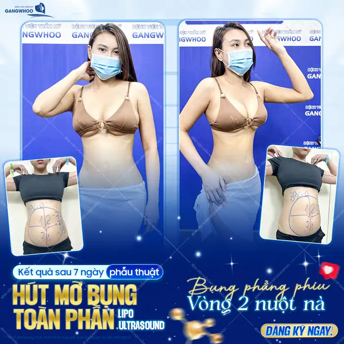 Bác sĩ hút mỡ bụng giỏi ở TP.HCM gồm những ai? Top 5+ bác sĩ uy tín