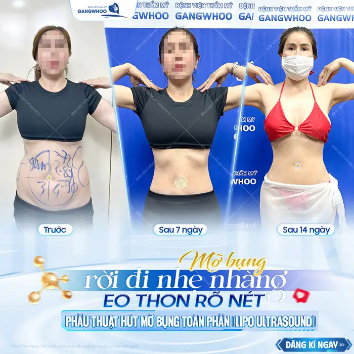 Bác sĩ hút mỡ bụng giỏi ở TP.HCM gồm những ai? Top 5+ bác sĩ uy tín