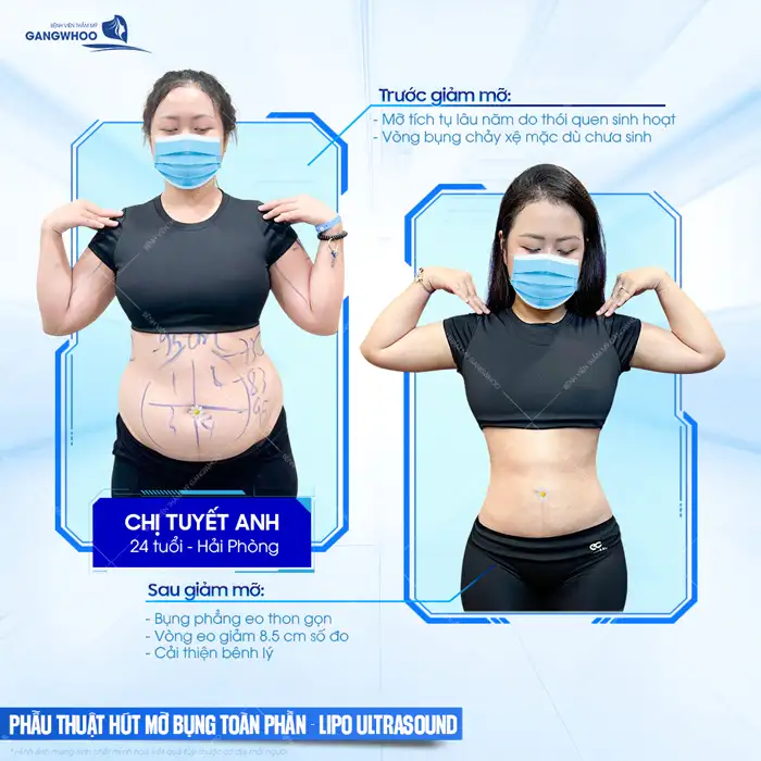 Bác sĩ hút mỡ bụng giỏi ở TP.HCM gồm những ai? Top 5+ bác sĩ uy tín