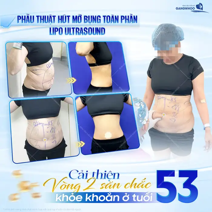 Bác sĩ hút mỡ bụng giỏi ở TP.HCM gồm những ai? Top 5+ bác sĩ uy tín