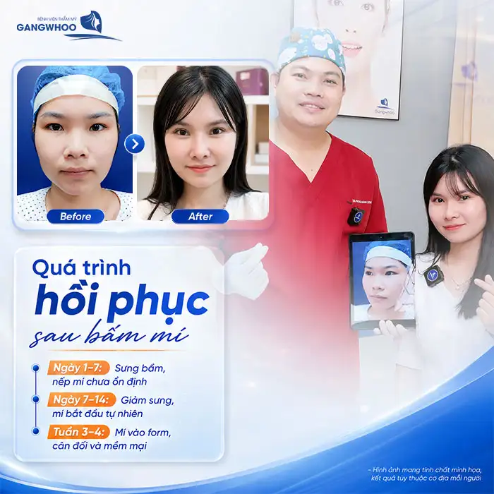 Bấm mí mắt bao lâu thì đẹp? Mốc thời gian phục hồi