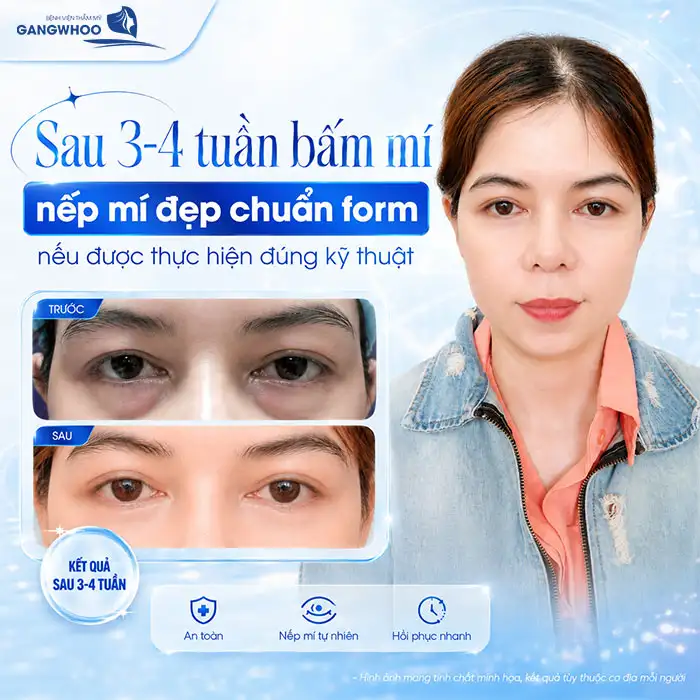 Bấm mí mắt bao lâu thì đẹp? Mốc thời gian phục hồi