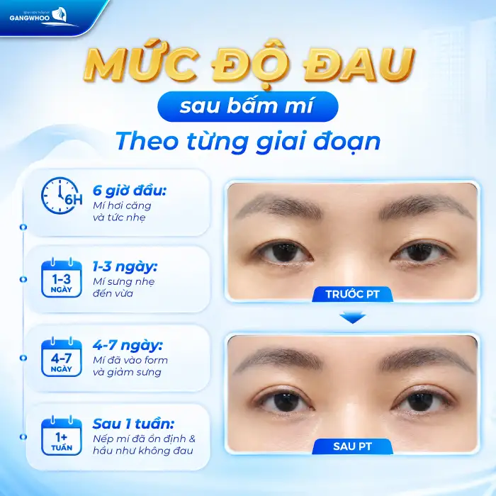 Bấm mí có đau không? Bác sĩ giải đáp cảm giác sau khi bấm mí