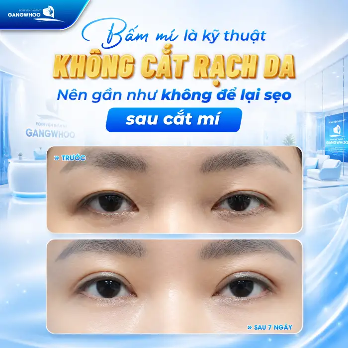 Bấm mí có để lại sẹo không? Cách chăm sóc tránh gây sẹo sau cắt mí