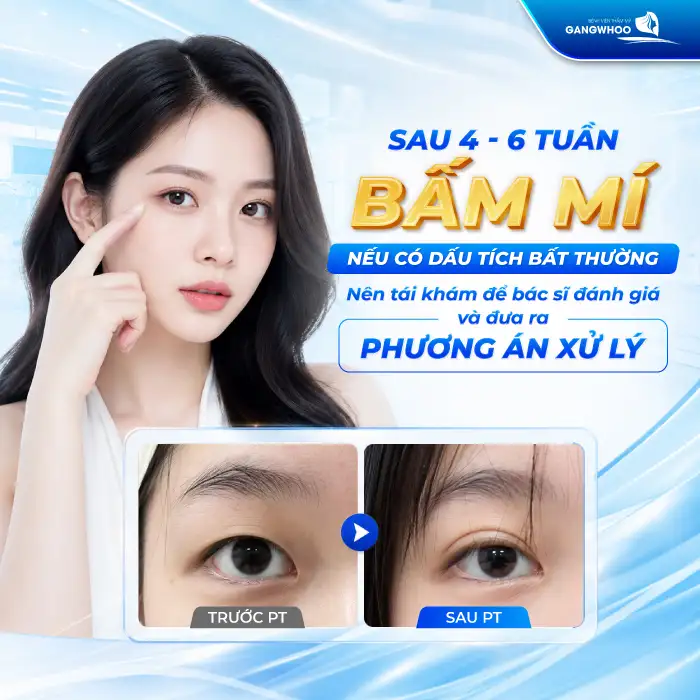 Bấm mí có để lại sẹo không? Cách chăm sóc tránh gây sẹo sau cắt mí