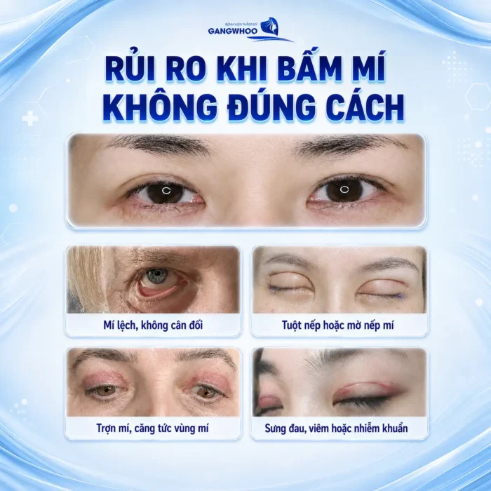 Bấm mí mắt có hại không? Bác sĩ giải đáp rủi ro và độ an toàn