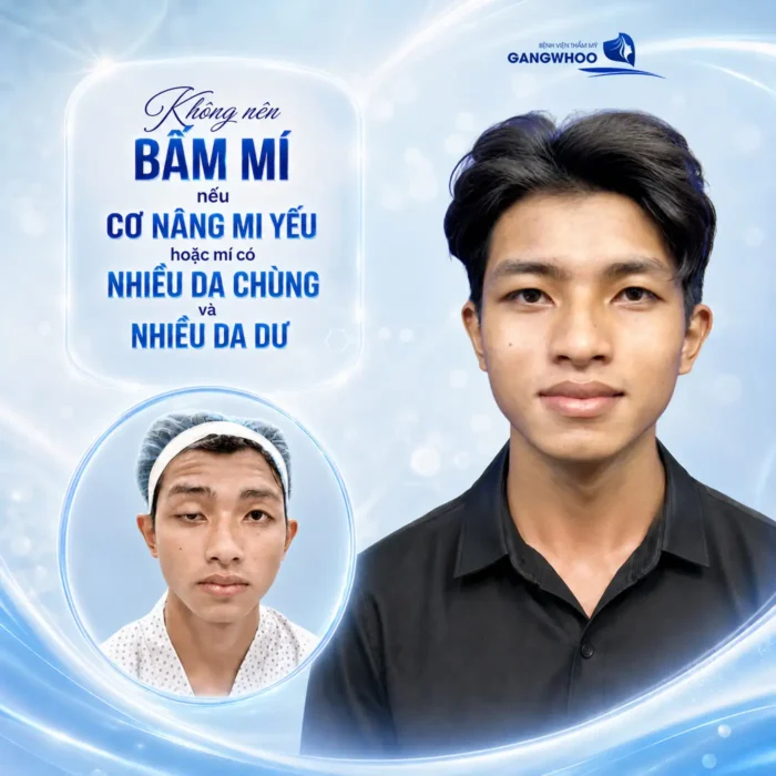 Bấm mí mắt có hại không? Bác sĩ giải đáp rủi ro và độ an toàn