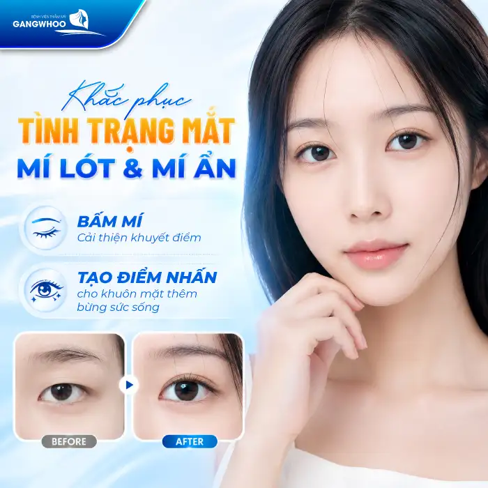 Bấm mí có làm mắt to? Có ảnh hưởng đến dáng mắt không?
