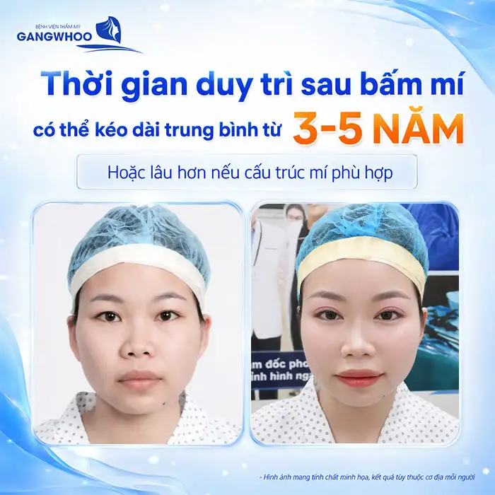 Bấm mí có vĩnh viễn không? Cách duy trì độ bền sau bấm mí