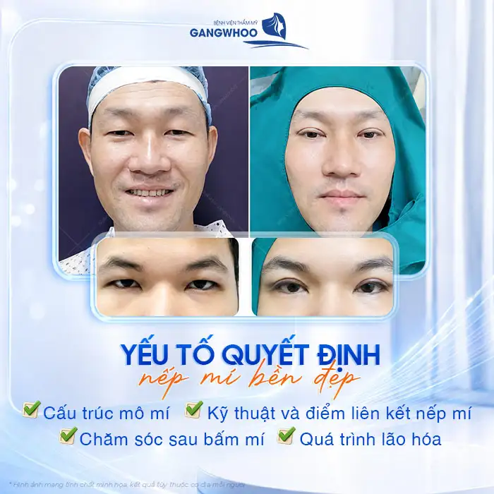 Bấm mí có vĩnh viễn không? Cách duy trì độ bền sau bấm mí
