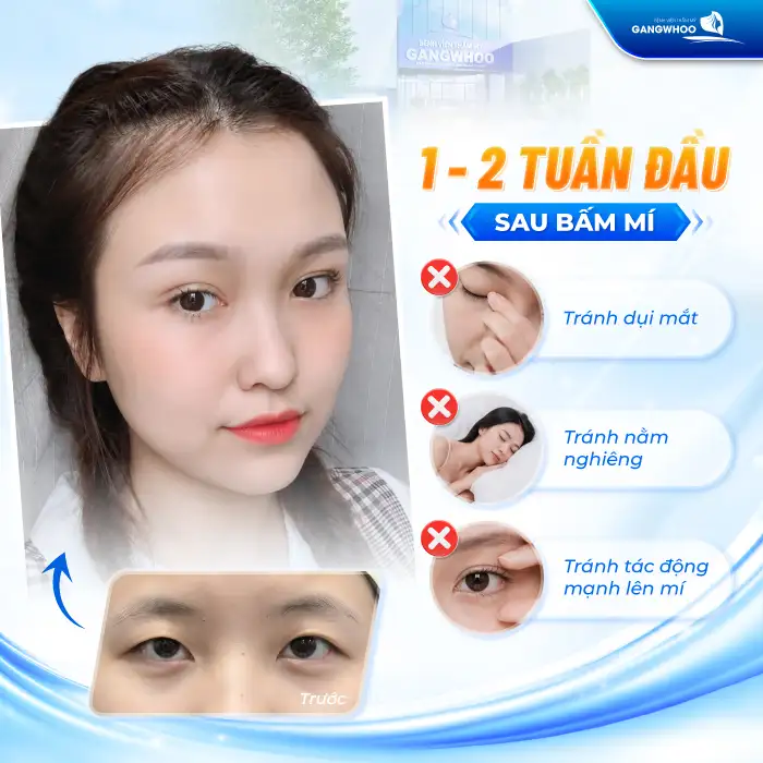 Bấm mí Hàn Quốc có vĩnh viễn? Những yếu tố quyết định đến độ bền