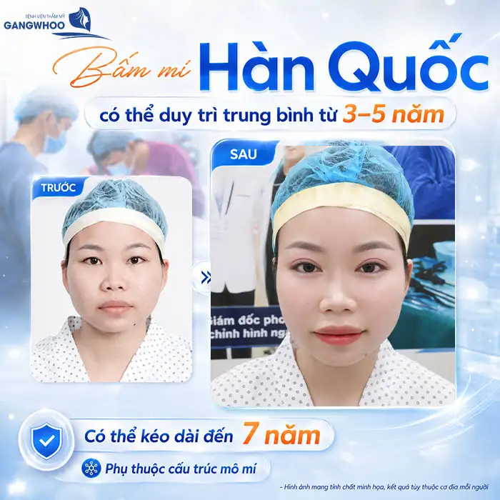 Bấm mí Hàn Quốc được bao lâu? Có giữ được nếp mí lâu dài