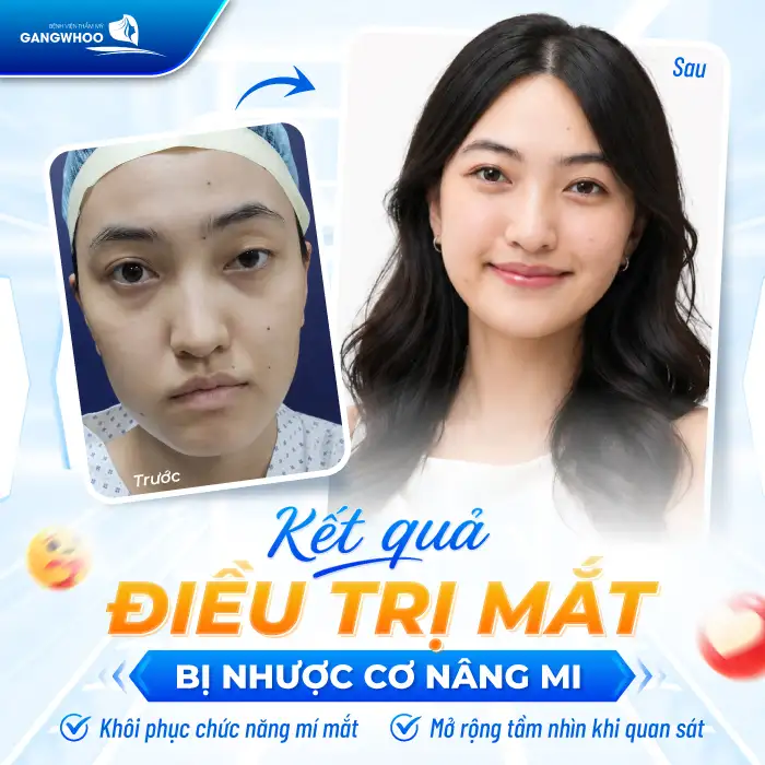 Bấm huyệt chữa sụp mí mắt có hiệu quả không? Thực hư ra sao