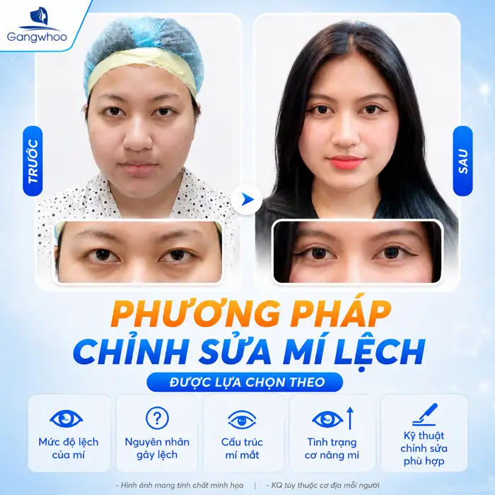 Bấm mí không đều có sửa được không? Cách khắc phục ra sao