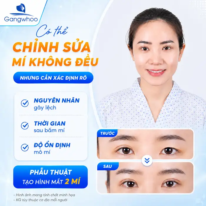 Bấm mí không đều có sửa được không? Cách khắc phục ra sao