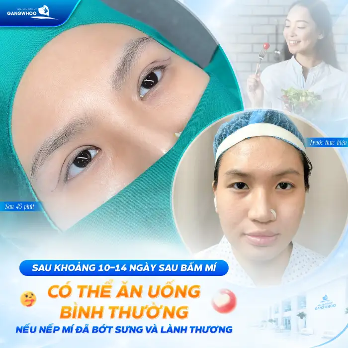Bấm mí mắt kiêng ăn gì? Chế độ dinh dưỡng giúp nhanh lành