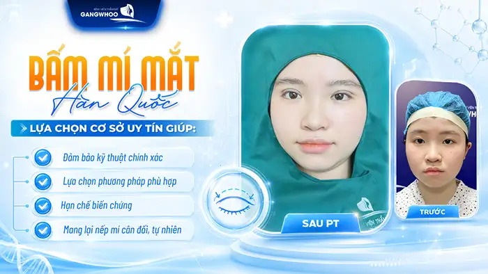 Bấm mí mắt Hàn Quốc ở đâu đẹp? Tiêu chí chọn địa chỉ uy tín