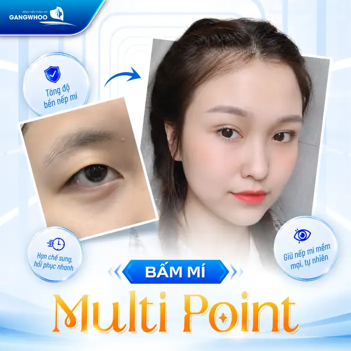 Bấm mí Multi Point là gì? Ưu – nhược điểm của phương pháp