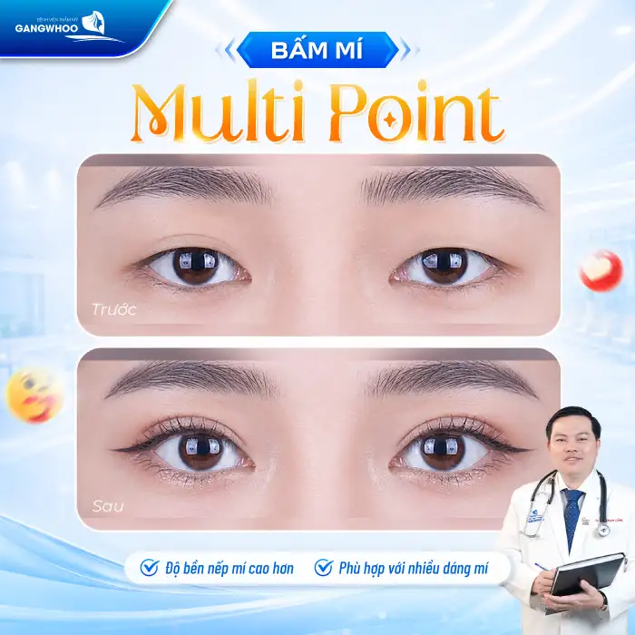 Bấm mí Multi Point là gì? Ưu – nhược điểm của phương pháp